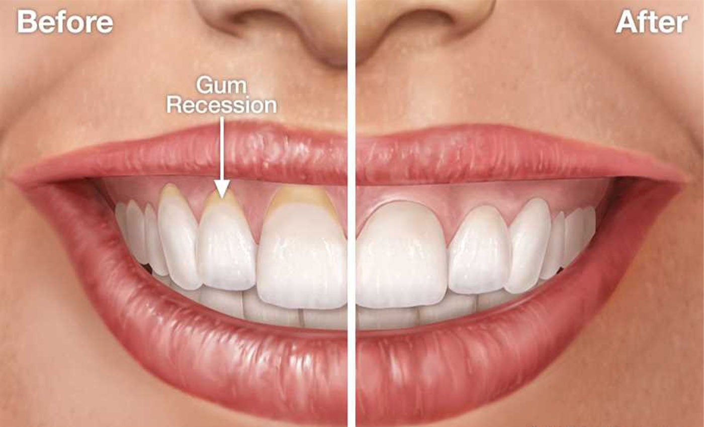 Gum Contouring treatment at Dr. Varshney's Dental Aesthetics in Nani Daman